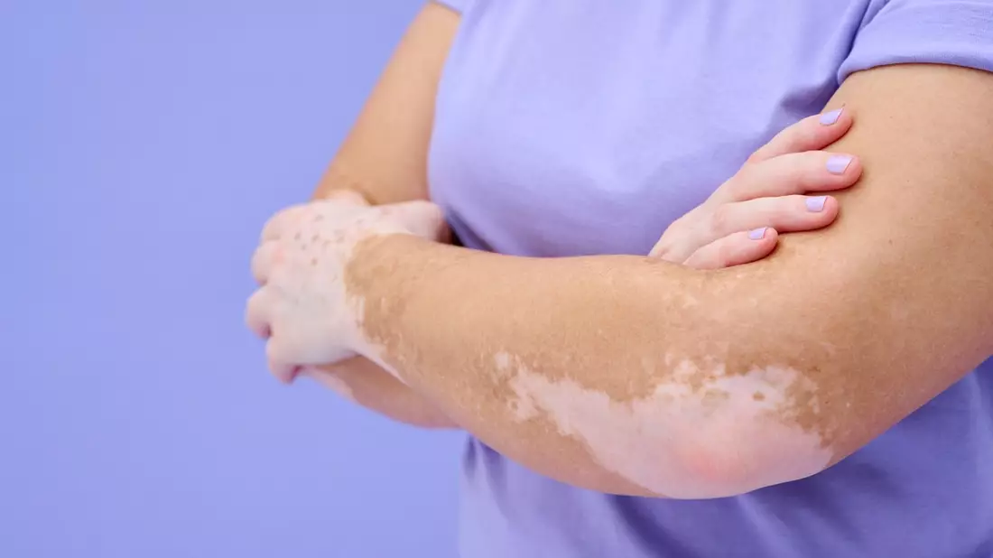 Beratung für Vitiligo-Betroffene: Incyte Deutschland unterstützt die Hautwochen - Bild: presseportal.de