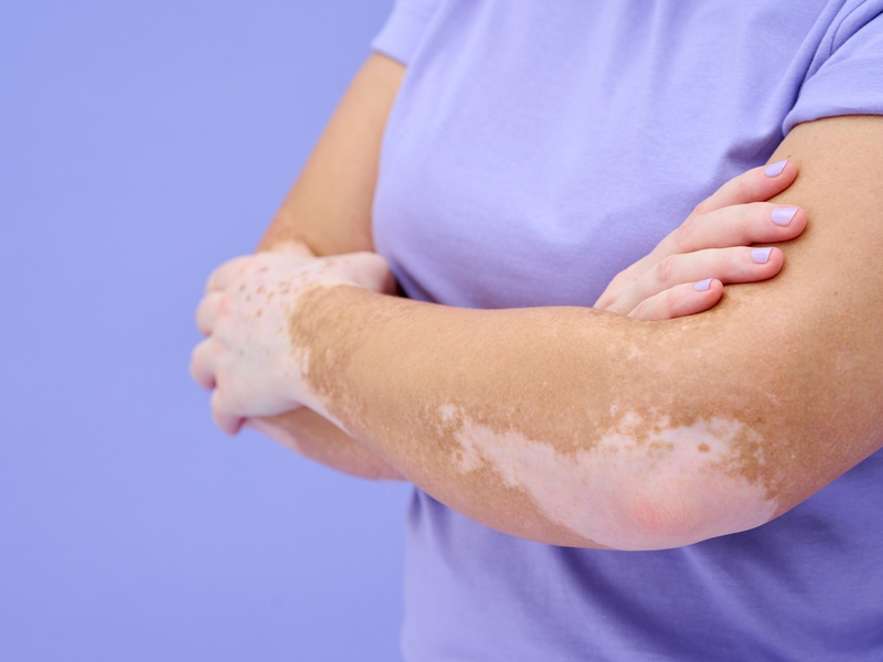 Beratung für Vitiligo-Betroffene: Incyte Deutschland unterstützt die Hautwochen - Foto: presseportal.de