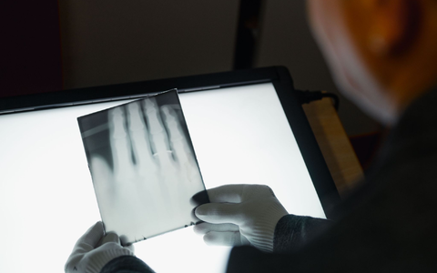 Ein Röntgenbild der Hand von Wilhelm Röntgen gehört nun zum  Unesco-Weltdokumentenerbe. (Archivbild) - Foto: Marius Becker/dpa