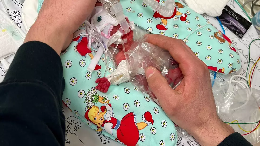 Etwas mehr als ein Päckchen Butter wog die kleine Marie, als sie im Februar zur Welt kam. Seitdem ist das Kind gut gewachsen. - Bild: Privat/Kinderklinik Dritter Orden Passau/dpa