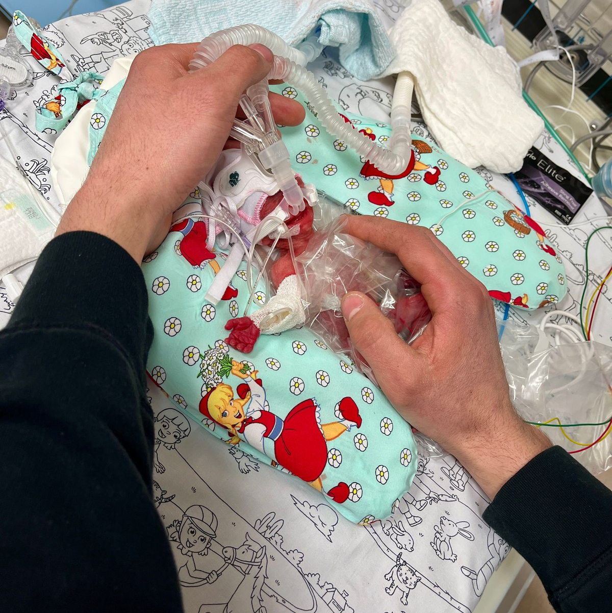 Etwas mehr als ein Päckchen Butter wog die kleine Marie, als sie im Februar zur Welt kam. Seitdem ist das Kind gut gewachsen. - Foto: Privat/Kinderklinik Dritter Orden Passau/dpa