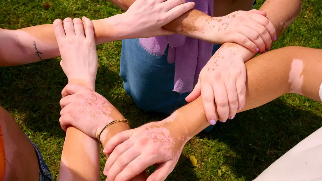Weißfleckenkrankheit in Deutschland: Neue Daten zeigen Lücken in Versorgung und Aufklärung von Menschen mit Vitiligo - Bild: presseportal.de