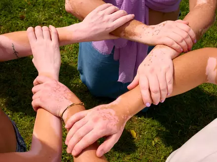 Weißfleckenkrankheit in Deutschland: Neue Daten zeigen Lücken in Versorgung und Aufklärung von Menschen mit Vitiligo - Foto: presseportal.de