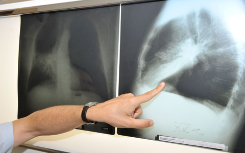 Ein Arzt zeigt auf ein Röntgenbild von einer von Krebs befallenen Lunge. (Illustration) - Foto: Felix Hörhager/dpa Ein Arzt zeigt auf ein Röntgenbild von einer von Krebs befallenen Lunge. (Illustration) - Foto: Felix Hörhager/dpa
