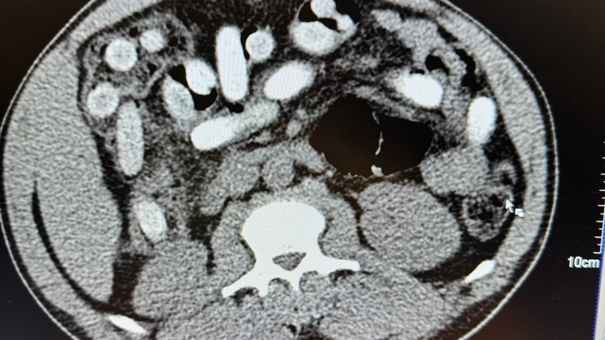 HZA-K: Kölner Zoll stellt Körperschmuggler im Bus und im Zug / 50-jähriger Italiener stellt mit rund 1,3 Kilogramm Kokain im Bauch neuen traurigen Rekord auf - Mutter und Tochter verstecken Heroin im Körper - Foto: presseportal.de