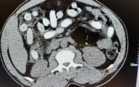 HZA-K: Kölner Zoll stellt Körperschmuggler im Bus und im Zug / 50-jähriger Italiener stellt mit rund 1,3 Kilogramm Kokain im Bauch neuen traurigen Rekord auf - Mutter und Tochter verstecken Heroin im Körper - Foto: presseportal.de