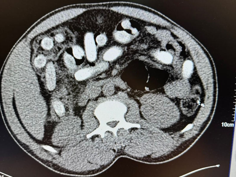 HZA-K: Kölner Zoll stellt Körperschmuggler im Bus und im Zug / 50-jähriger Italiener stellt mit rund 1,3 Kilogramm Kokain im Bauch neuen traurigen Rekord auf - Mutter und Tochter verstecken Heroin im Körper - Foto: presseportal.de