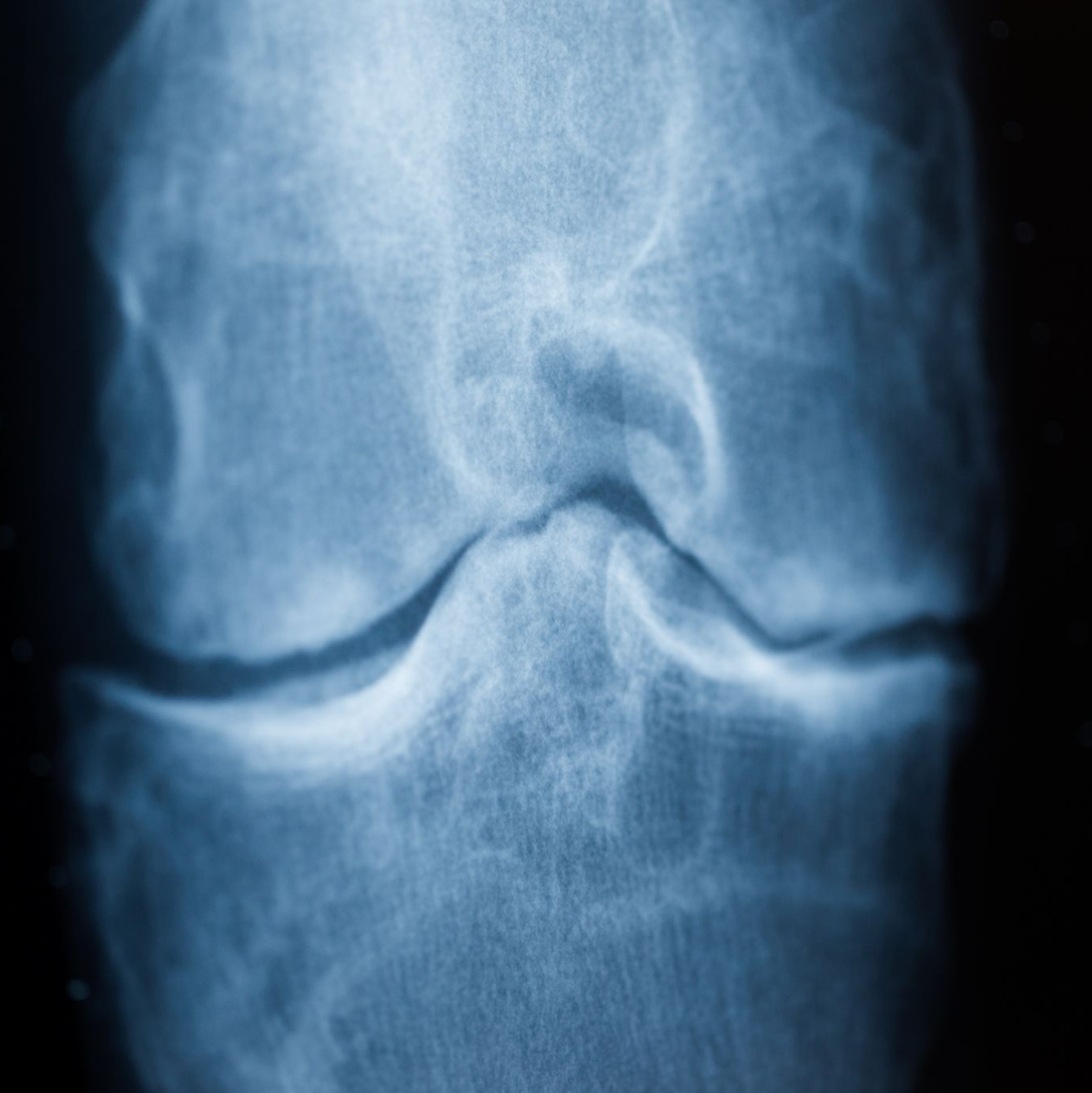 Spätestens das Röntgenbild schafft Klarheit: Der Knorpel nutzt sich immer mehr ab. Im späteren Stadium einer Arthrose reibt Knochen direkt auf Knochen. (Archivbild) - Foto: Rolf Vennenbernd/dpa/dpa-tmn