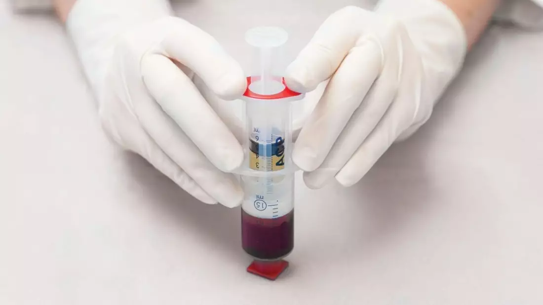 Bioregenerative Therapie von Arthrosen und Sportverletzungen - Mit ACP aus dem eigenen Blut direkt in Gelenke, Muskeln oder Sehnen - Bild: presseportal.de
