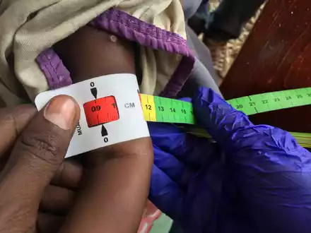 Ein Arzt misst im Sudan den Armumfang eines schwer unterernährten Babys (Archivbild) - Foto: Eva-Maria Krafczyk/dpa