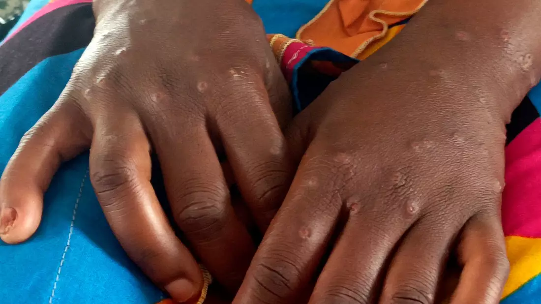 Mpox ist vor allem für kleine Kinder und immungeschwächte Menschen gefährlich (Archivbild) - Bild: Janvier Barhahiga/AP/dpa