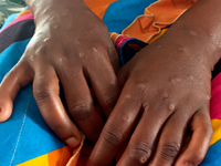 Mpox ist vor allem für kleine Kinder und immungeschwächte Menschen gefährlich (Archivbild) - Foto: Janvier Barhahiga/AP/dpa