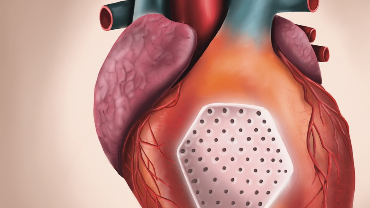 Bahnbrechende Therapie bei fortgeschrittener Herzinsuffizienz: Biotech-Unternehmen Repairon erhält Serie-A-Finanzierung für klinische Weiterentwicklung des Herzpflasters - Foto: presseportal.de