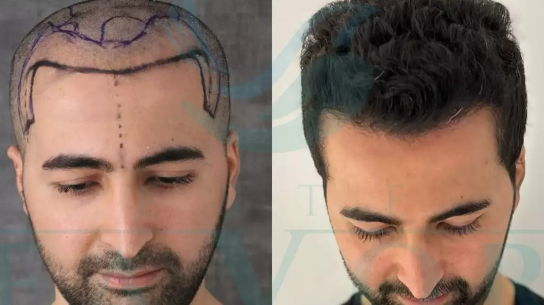 Top 10 Beste Haartransplantation Kliniken in der Türkei - Bild: presseportal.de