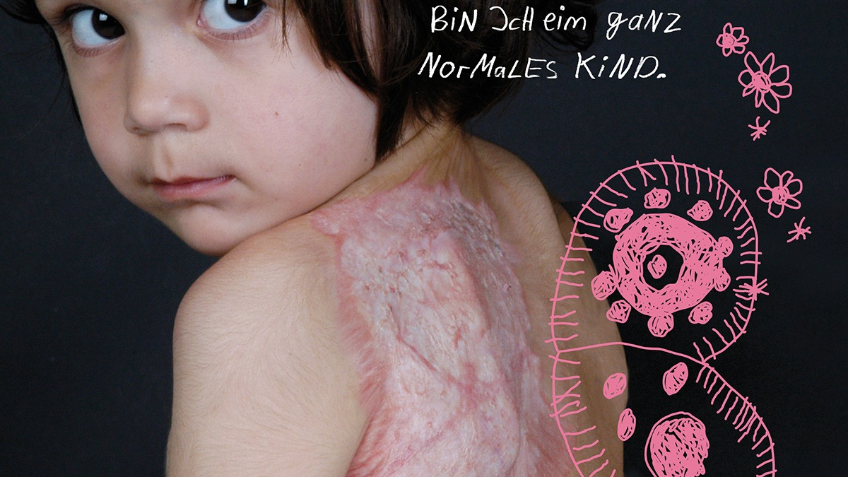 FW Weinheim: Tag des brandverletzten Kindes Gemeinsam Kraft geben, Prävention stärken - Foto: presseportal.de