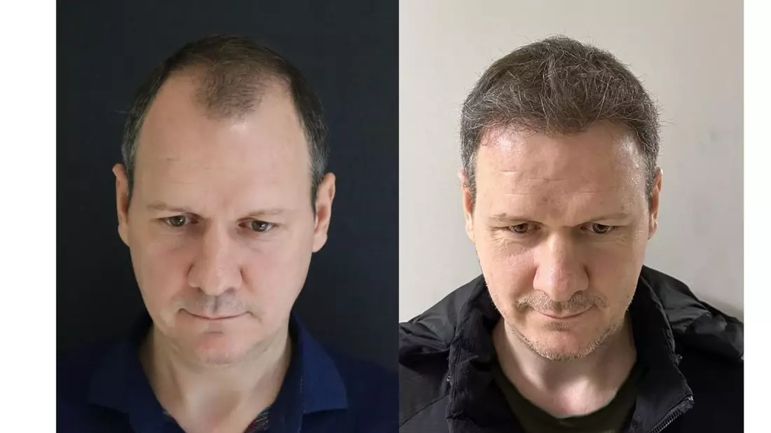 Die 10 Besten Haartransplantationskliniken in der Türkei - Kosten, Dauer & Erholungszeit - Bild: presseportal.de
