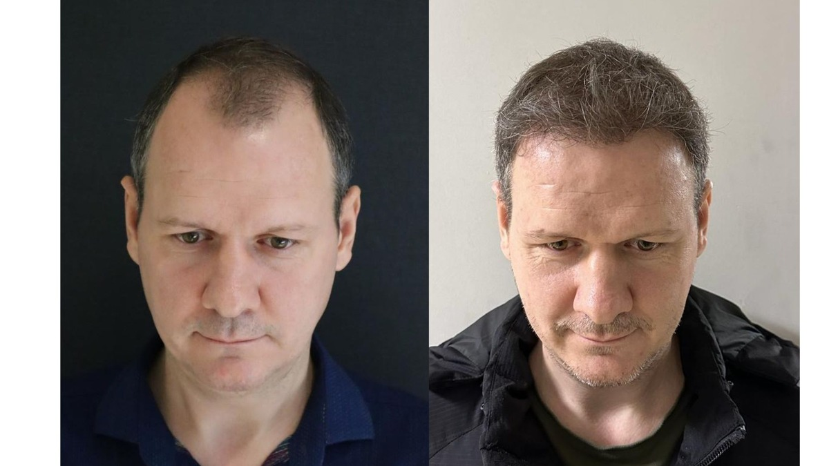 Die 10 Besten Haartransplantationskliniken in der Türkei - Kosten, Dauer & Erholungszeit - Foto: presseportal.de