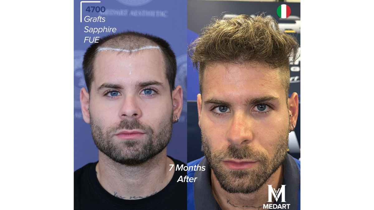 Die 10 besten Haartransplantationszentren in der Türkei: Kompletter Ratgeber für ausländische Patienten 2026 - Foto: presseportal.de