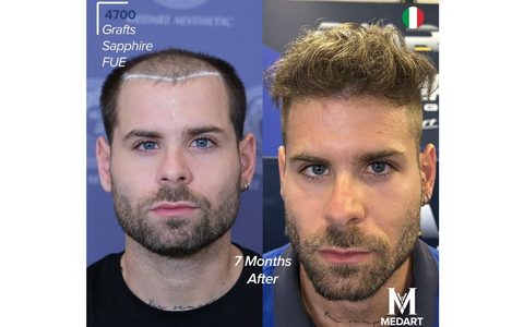 Die 10 besten Haartransplantationszentren in der Türkei: Kompletter Ratgeber für ausländische Patienten 2026 - Foto: presseportal.de