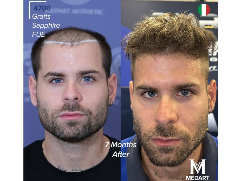 Die 10 besten Haartransplantationszentren in der Türkei: Kompletter Ratgeber für ausländische Patienten 2026 - Foto: presseportal.de