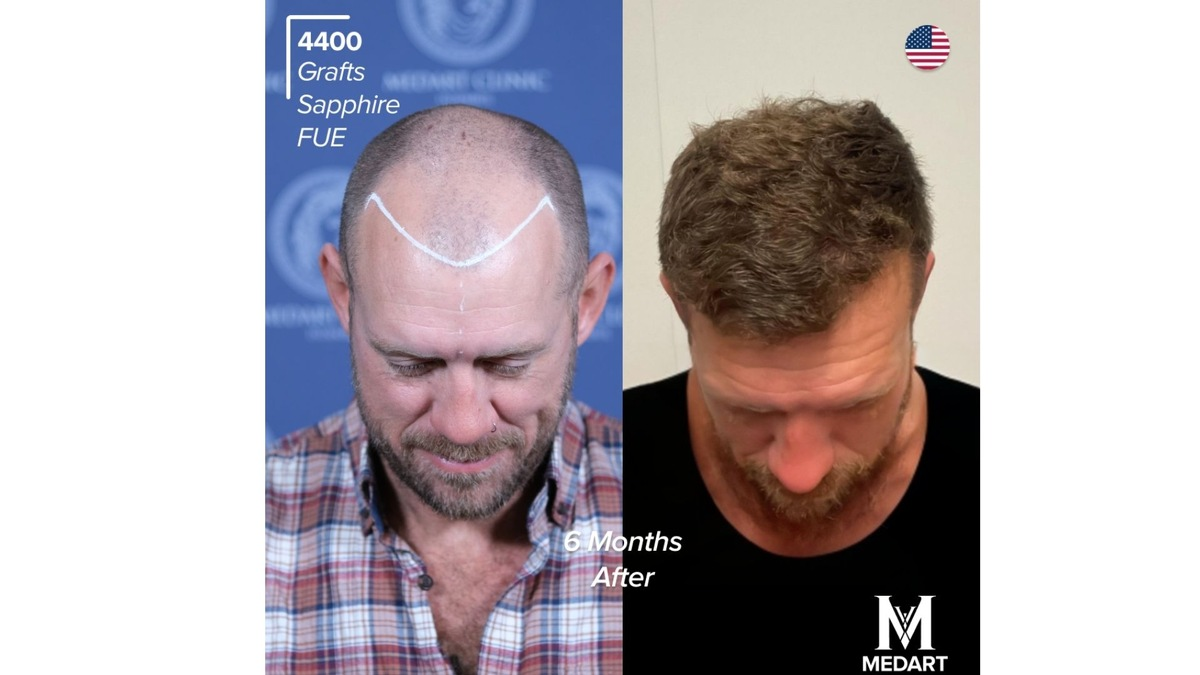 Die 10 Besten Haartransplantationszentren in der Türkei: Schmerzen, Komfort und häufige Patientenfragen - Foto: presseportal.de