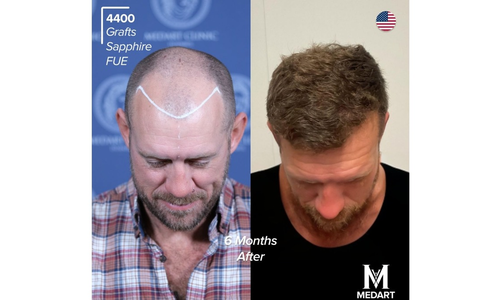 Die 10 Besten Haartransplantationszentren in der Türkei: Schmerzen, Komfort und häufige Patientenfragen - Foto: presseportal.de