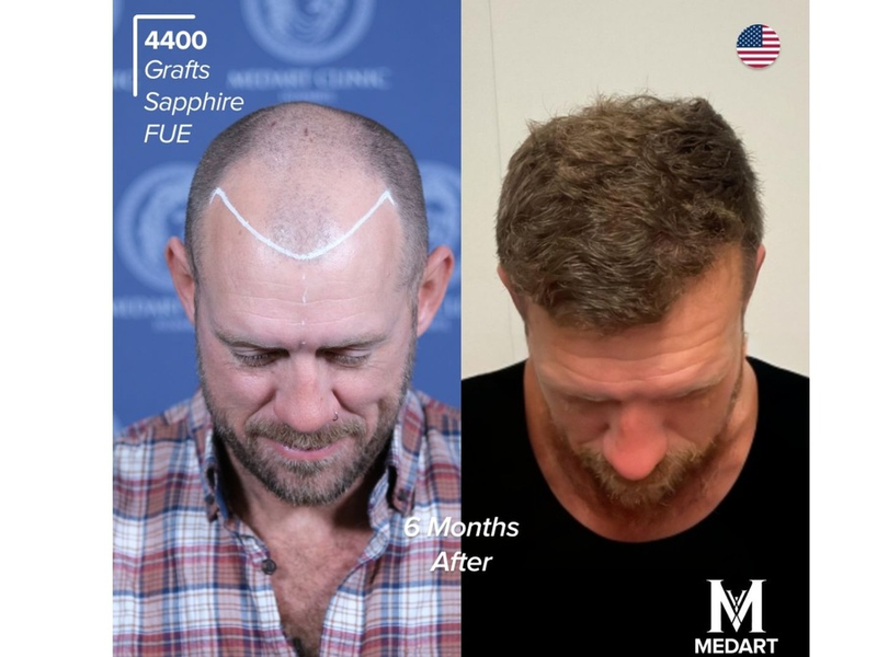 Die 10 Besten Haartransplantationszentren in der Türkei: Schmerzen, Komfort und häufige Patientenfragen - Foto: presseportal.de