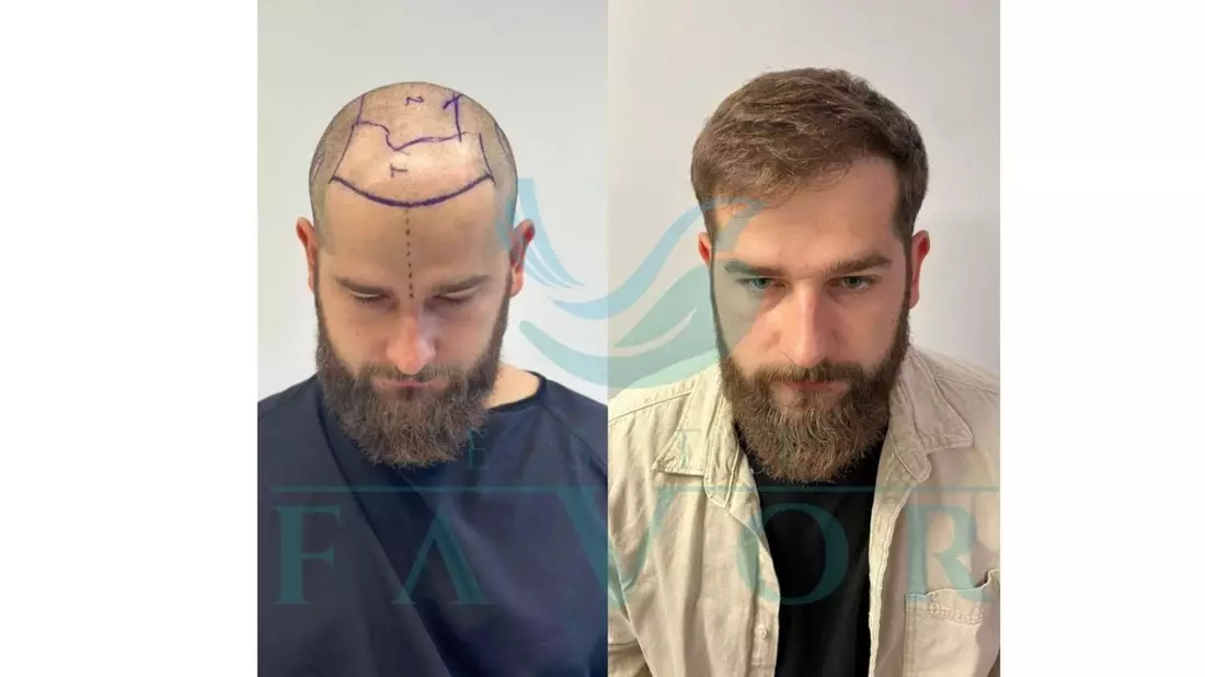 Die 10 besten Haartransplantationskliniken in der Türkei - Risiken, Sicherheit & Qualität - Bild: presseportal.de