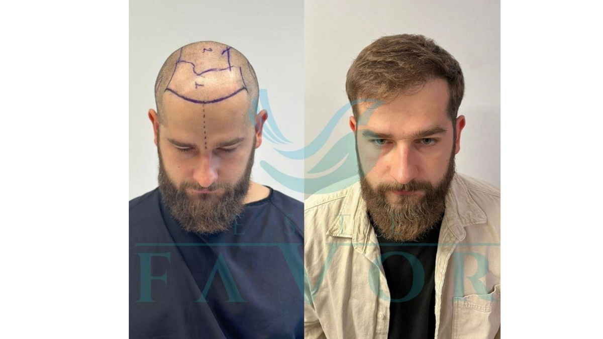 Die 10 besten Haartransplantationskliniken in der Türkei - Risiken, Sicherheit & Qualität - Foto: presseportal.de