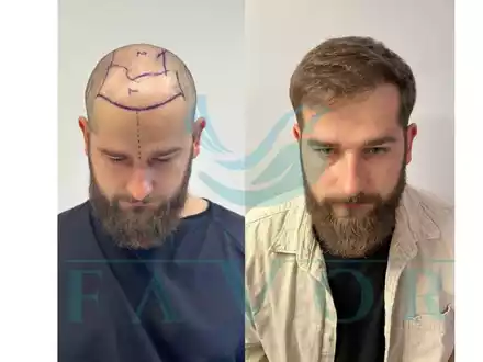 Die 10 besten Haartransplantationskliniken in der Türkei - Risiken, Sicherheit & Qualität - Foto: presseportal.de