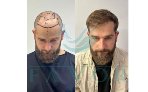 Die 10 besten Haartransplantationskliniken in der Türkei - Risiken, Sicherheit & Qualität - Foto: presseportal.de