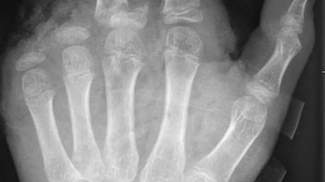 So kann ein Röntgenbild nach einer missglückten Böllerexplosion aussehen: Zwei Finger fehlen.  - Bild: -/UKB/dpa