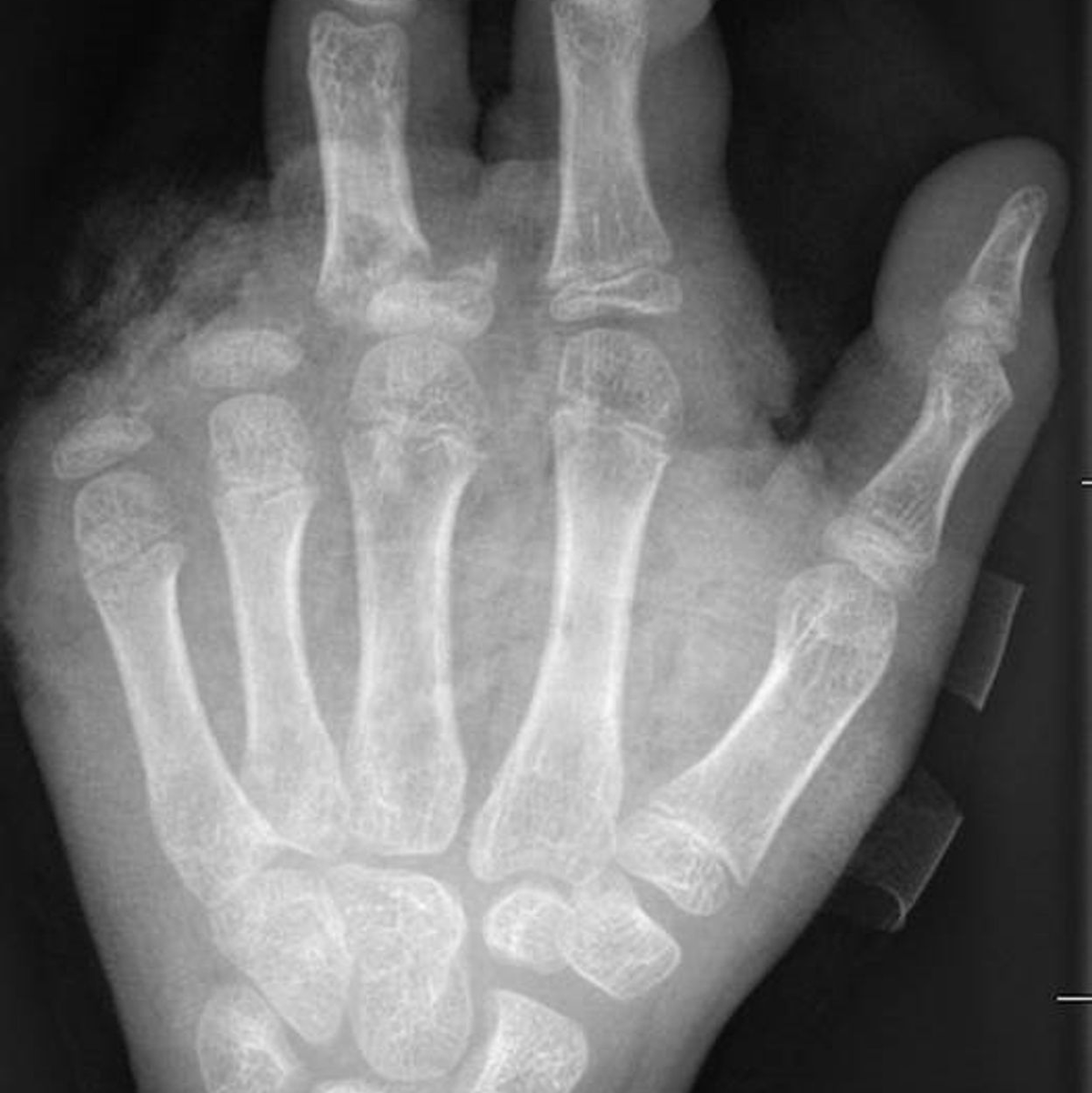 So kann ein Röntgenbild nach einer missglückten Böllerexplosion aussehen: Zwei Finger fehlen.  - Foto: -/UKB/dpa