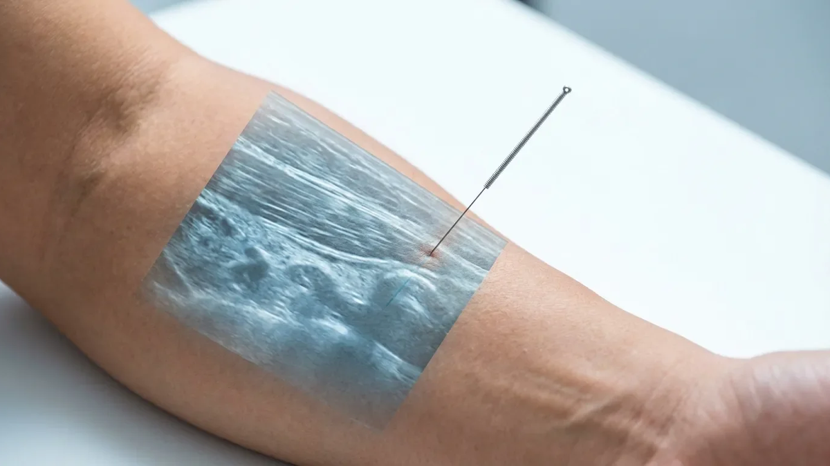 Akupunktur-Studie revolutioniert Behandlung von Schulterschmerzen - Foto: über boerse-global.de