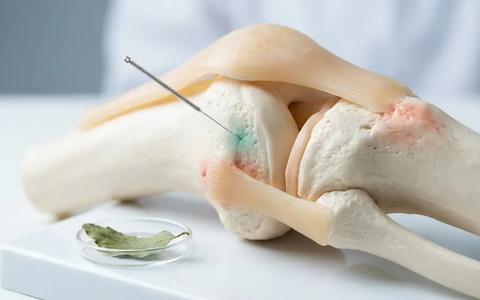 Akupunktur-Studie 2026: So bekämpft Elektroakupunktur Kniearthrose - Foto: über boerse-global.de