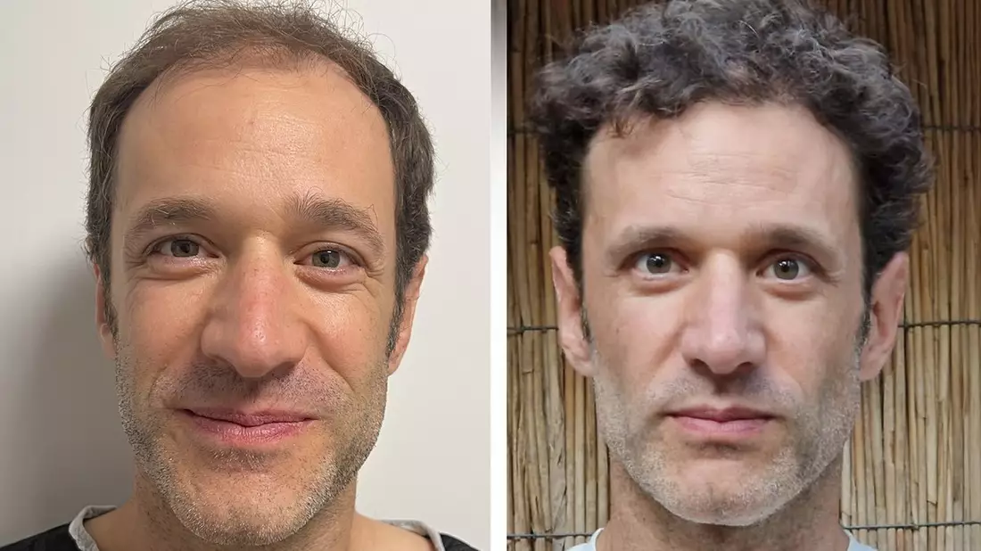 Haartransplantation Türkei Testsieger 2026: Die 10 besten Kliniken im großen Vergleich - Bild: presseportal.de