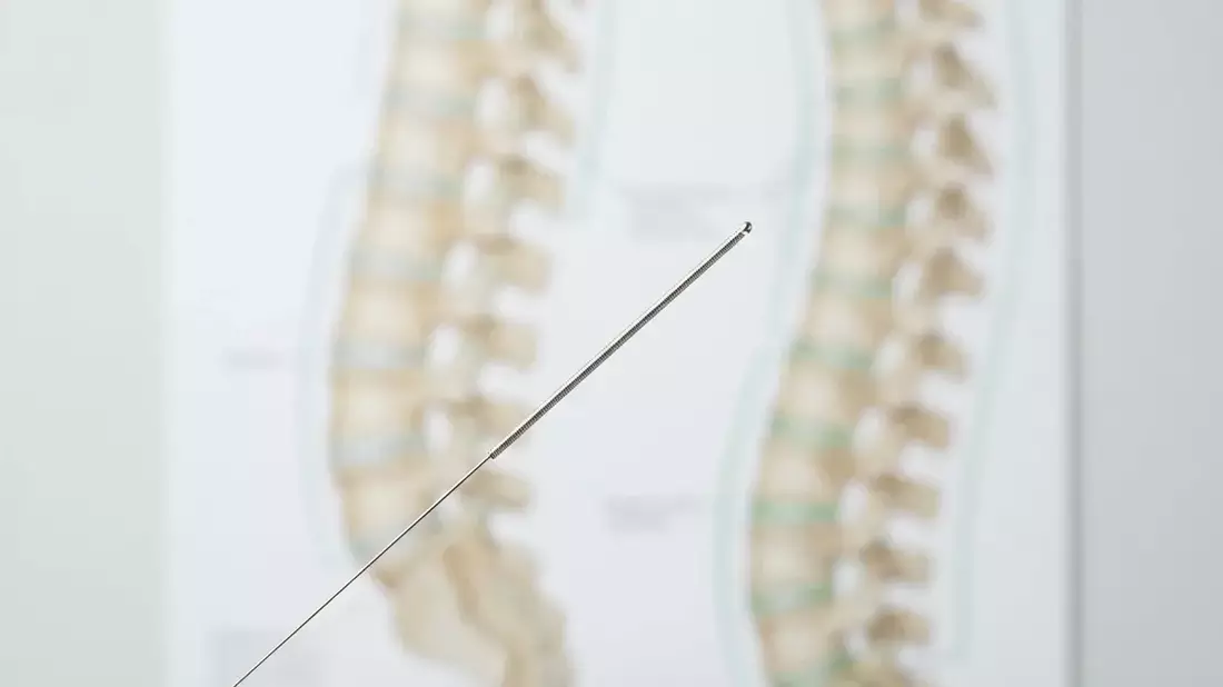 Studie: Mehr Akupunktur könnte Krankenkassen Millionen sparen - Bild: über boerse-global.de
