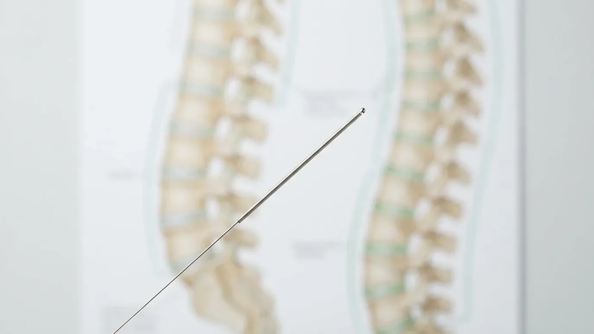 Studie: Mehr Akupunktur könnte Krankenkassen Millionen sparen - Foto: über boerse-global.de