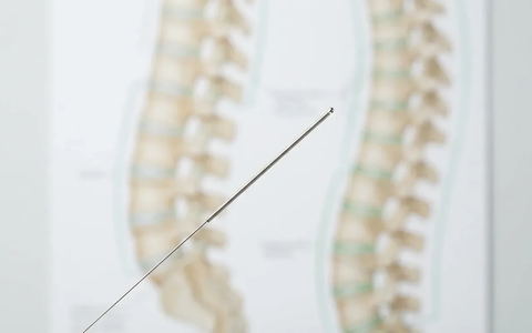 Studie: Mehr Akupunktur könnte Krankenkassen Millionen sparen - Foto: über boerse-global.de