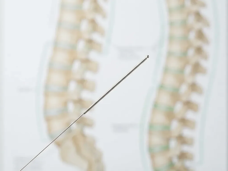 Studie: Mehr Akupunktur könnte Krankenkassen Millionen sparen - Foto: über boerse-global.de