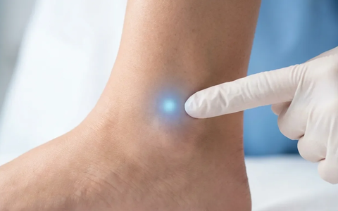 Akupunktur-Punkt Kidney 7: Neue Leitlinie setzt auf Akupressur gegen Winter-Ödeme - Foto: über boerse-global.de