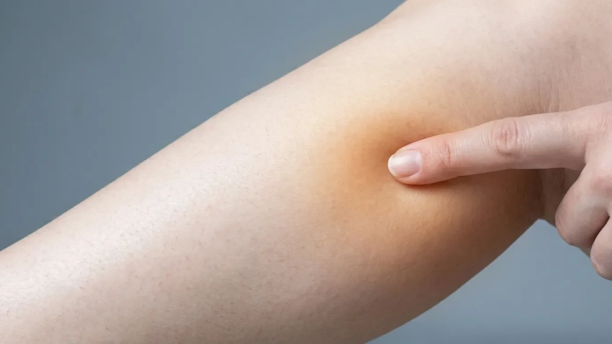 Akupressur-Punkt Chengshan: Erste Hilfe bei winterlichen Wadenkrämpfen - Foto: über boerse-global.de