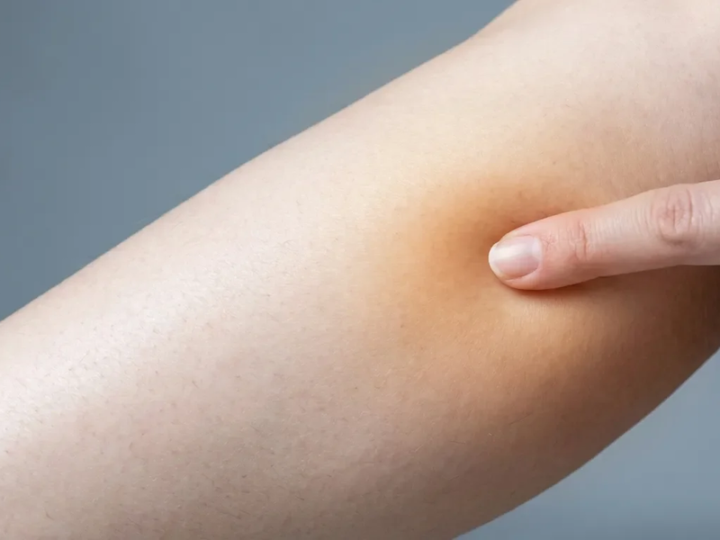 Akupressur-Punkt Chengshan: Erste Hilfe bei winterlichen Wadenkrämpfen - Foto: über boerse-global.de