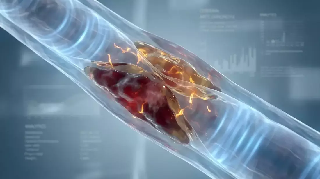 Cholesterin-Schwankungen erhöhen Demenzrisiko deutlich - Bild: über boerse-global.de