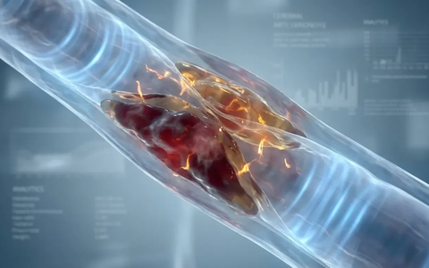 Cholesterin-Schwankungen erhöhen Demenzrisiko deutlich - Foto: über boerse-global.de