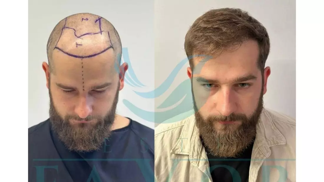 Haartransplantation Türkei 2026 - Die 10 besten Kliniken im großen Testsieger-Vergleich - Bild: presseportal.de