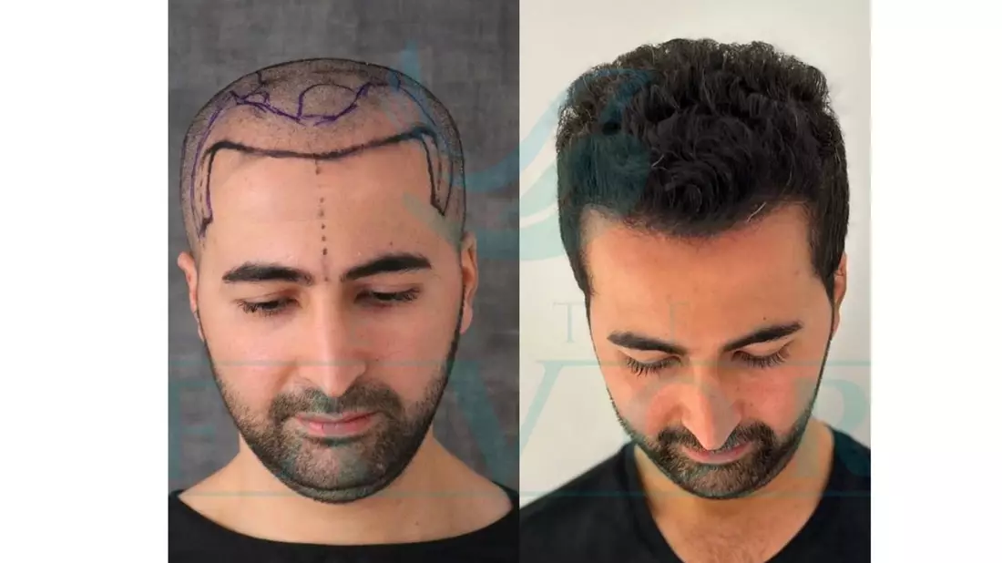 Top 10 Beste Haartransplantation Türkei in der Türkei 2026: testsieger Haartransplantationskliniken - Bild: presseportal.de