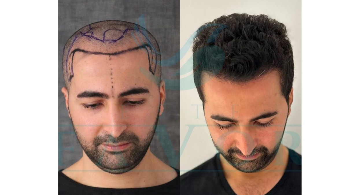Top 10 der besten Haartransplantationskliniken in der Türkei 2026 - Geprüft & verglichen - Foto: presseportal.de