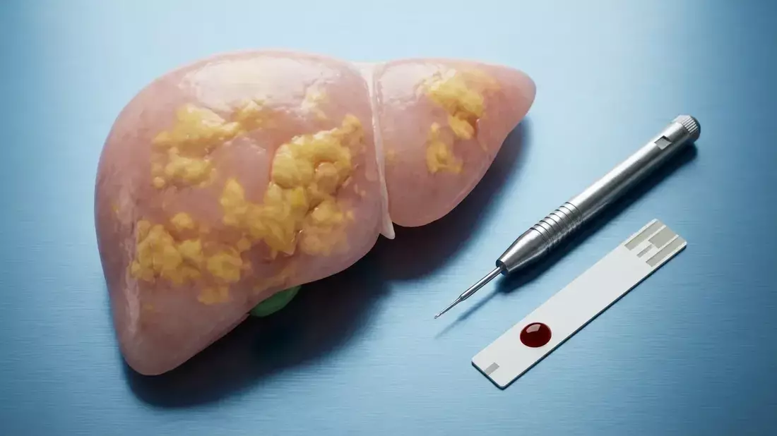 Keto-Diät: Studie warnt vor Fettleber und Diabetes-Risiko Illustration mit AI erstellt übermittelt durch boerse-global.de