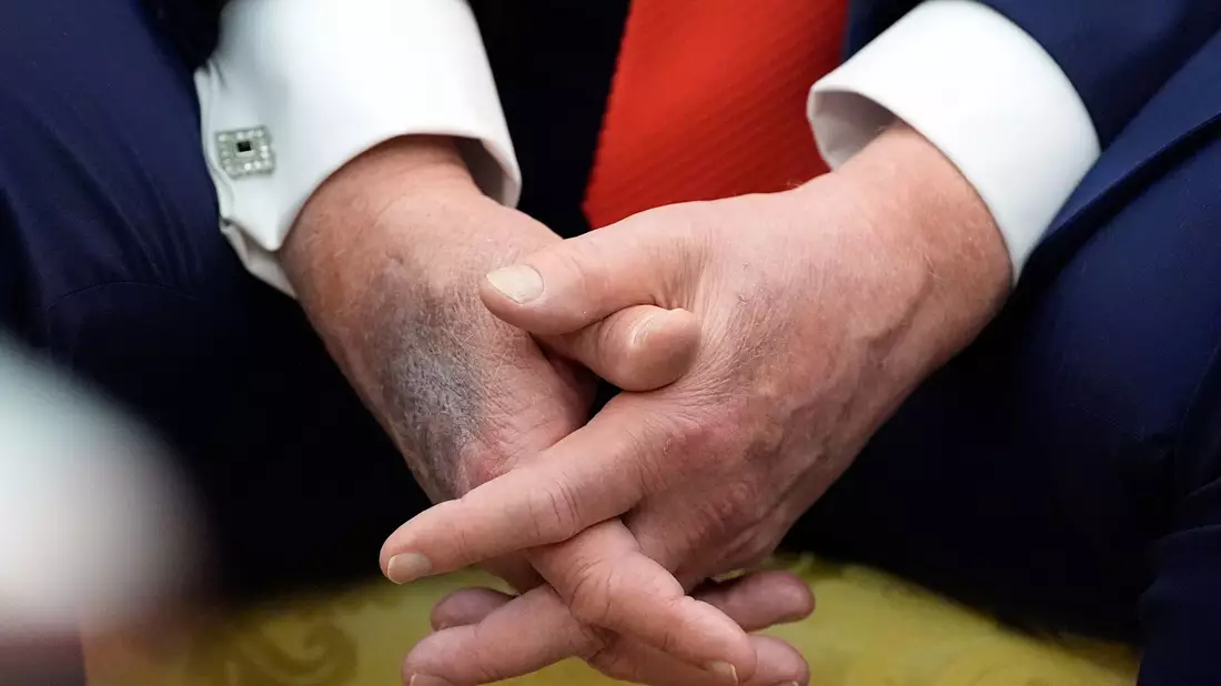 Blaue Flecken geben immer wieder Anlass für Spekulationen. (Archivbild) - Bild: Alex Brandon/AP/dpa
